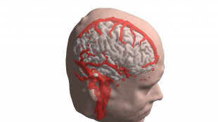 Ictus, per il recupero ha un ruolo decisivo l'emisfero opposto alla lesione