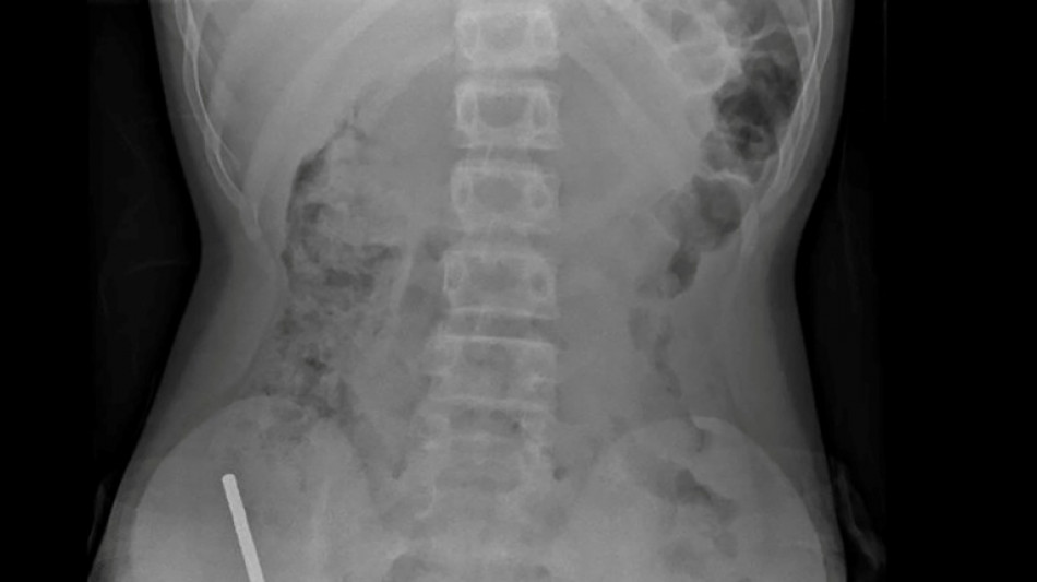 Surgeons remove up to 100 magnets from N. Zealand teen's gut